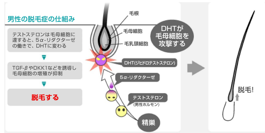 男性ホルモン（テストステロン）による薄毛のメカニズム