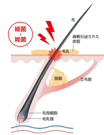 脂漏による薄毛のメカニズム