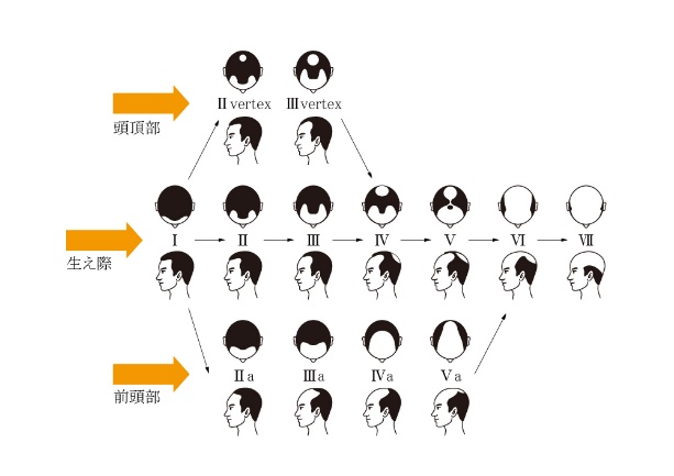 AGAのステージ分布図